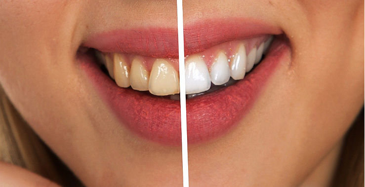 5 Popular Whitening Home Remedies: What the Science Actually Says